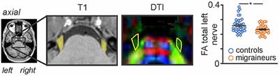 Alterations in brain structure associated with trigeminal nerve anatomy in episodic migraine
